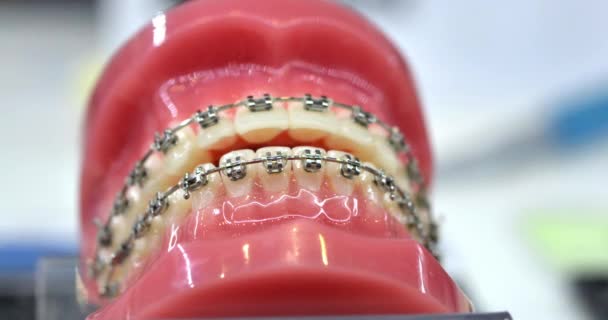 Braces sur les dents artificielles gros plan. La dentisterie dentaire. Appareils dentaires. — Video