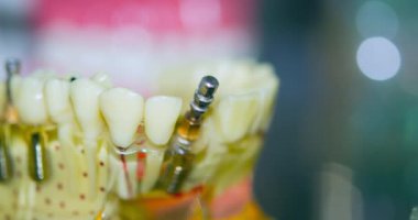 Yakın plan implantları olan şeffaf İnsan Dişleri Modeli