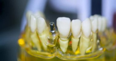 Yakın plan implantları olan şeffaf İnsan Dişleri Modeli