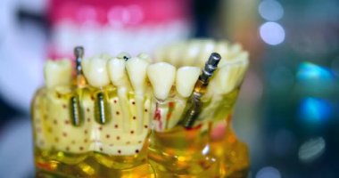 Yakın plan implantları olan şeffaf İnsan Dişleri Modeli