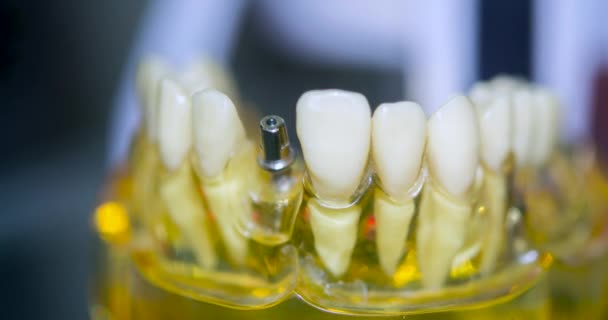 Transparentní model lidských zubů s implantáty zblízka — Stock video
