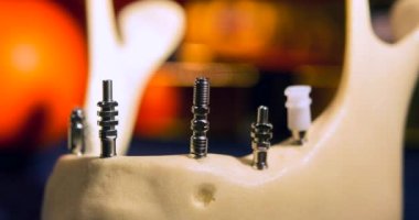 Yakın plan implantları olan şeffaf İnsan Dişleri Modeli