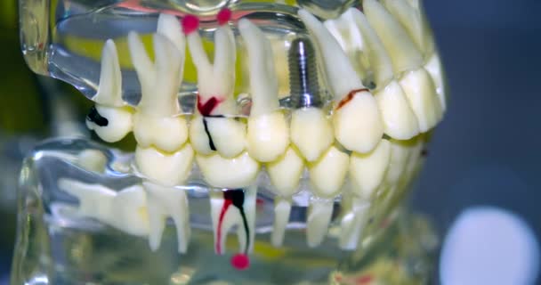 Modelo transparente de dientes humanos con implantes de primer plano — Vídeo de stock