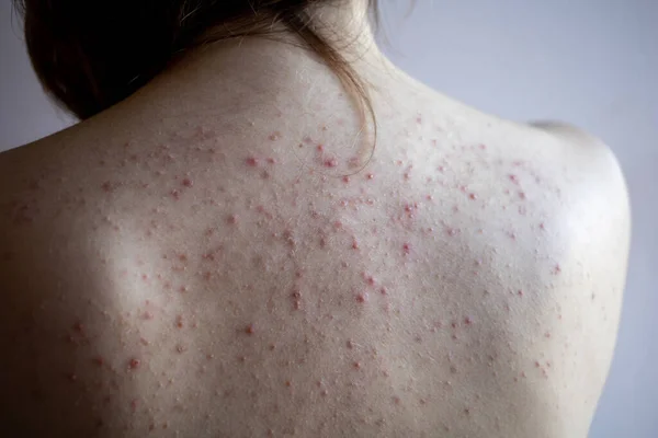 Mulher de volta com acne, manchas vermelhas, doença de pele — Fotografia de Stock