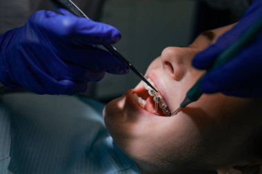 Diş hekimi hastaya diş teli takar. Yakın plan.