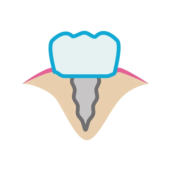 Icona del dente dell'impianto. Progettazione di cure dentistiche. Grafico vettoriale — Vettoriale Stock