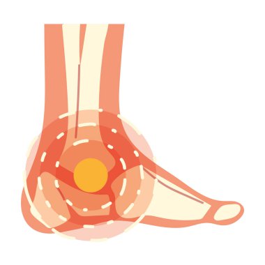 arthritis foot pain clipart