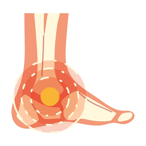 Artritis voetpijn — Stockvector