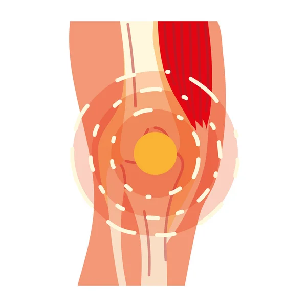 Artrite dor nas pernas — Vetor de Stock