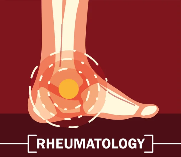 Huesos del tobillo reumatología — Vector de stock