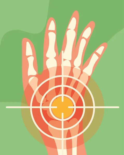 Reumatologia ossos da mão — Vetor de Stock