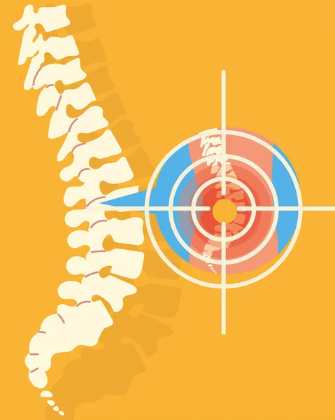 Rheumatology spine bones — Stock Vector