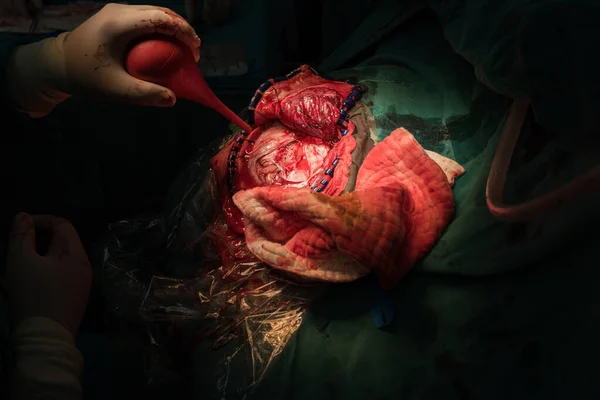 Chirurgie Cérébrale Intra Opératoire — Photo