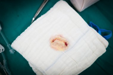 Romatizmal mitral kapak numune