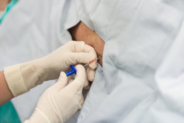Epidural Analjezi