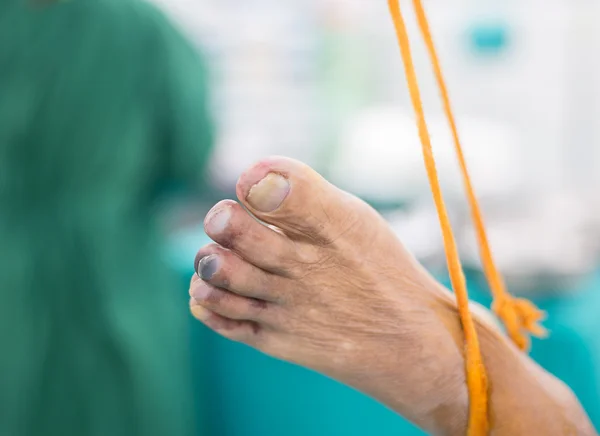 Blue toe syndrome — Stock Photo, Image