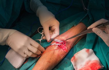 Arteriyovenöz fistül işlemi