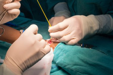 Arteriovenous fistula operation clipart