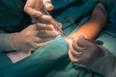 Arteriyovenöz fistül işlemi
