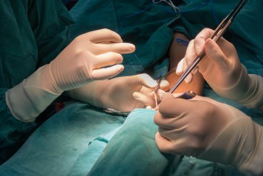 Arteriovenous fistula operation clipart