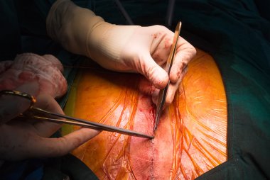 Dikiş yakın Göğüs kemiğindeki kesik