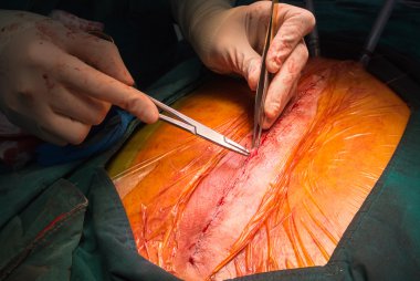 Dikiş yakın Göğüs kemiğindeki kesik