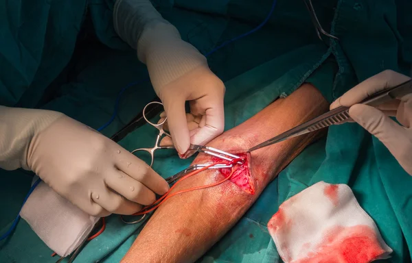 Arteriovenöse Fisteloperation — Stockfoto