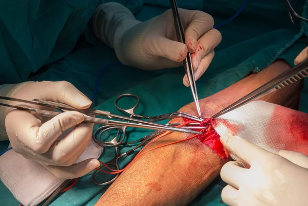 Arteriovenöse Fisteloperation — Stockfoto