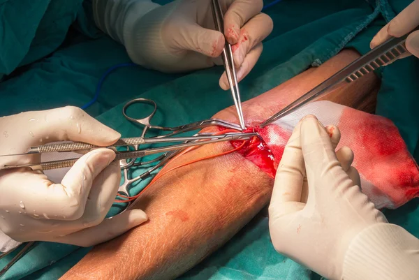 Arteriovenöse Fisteloperation — Stockfoto