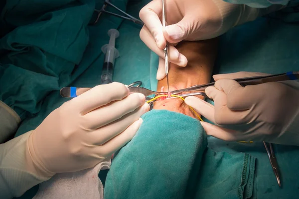 Arteriovenous fistula operation — Stock Photo, Image