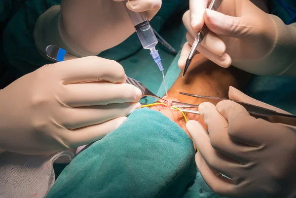 Arteriovenous fistula operation — Stock Photo, Image