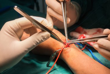 Arteriovenous fistula operation for dialysis clipart