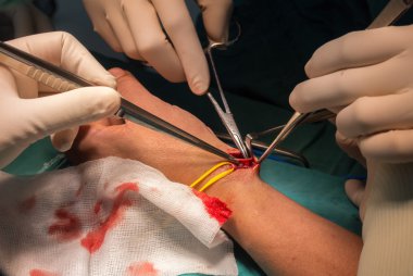 Radyal arter arteriyovenöz fistül için hazırlamak