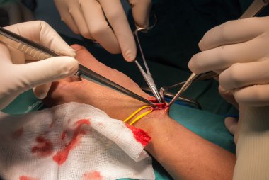 Prepare radial artery for arteriovenous fistula clipart