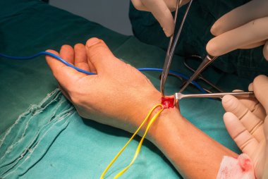 Radyal arter arteriyovenöz fistül için hazırlamak