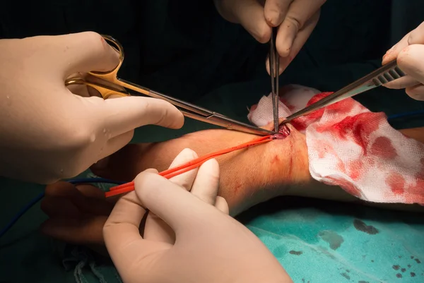 Opération de fistule artérioveineuse pour dialyse — Photo