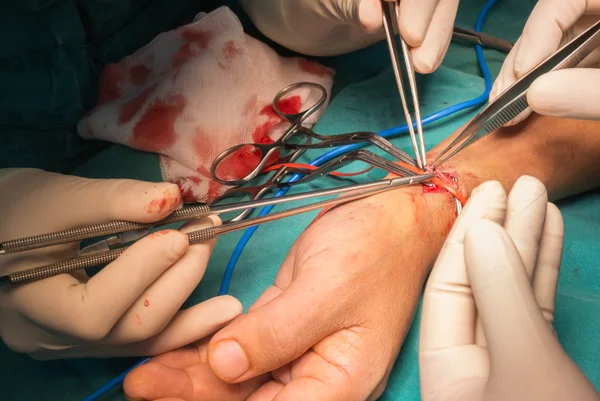 Arteriovenous fistula operation for dialysis — Stock Photo, Image