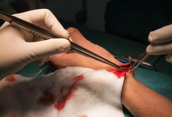 Preparare l'arteria radiale per la fistola arterovenosa — Foto Stock