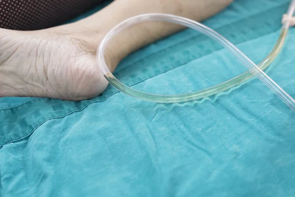 Retain foley catheter for surgery — Stock Photo, Image