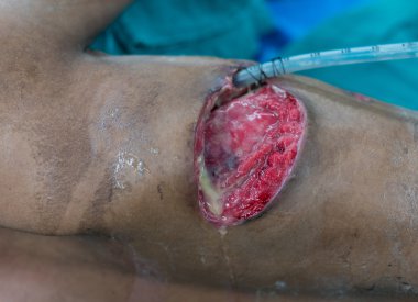 ampiyem thoracis enfekte göğüs duvarından