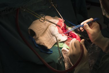 beyin cerrahı Kaldır beyin tümörü