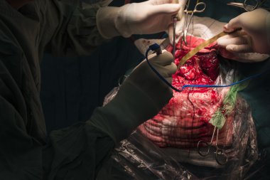 neurosurgeon remove brain tumor clipart