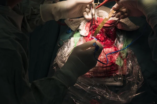 Neurochirurgo rimuovere il tumore al cervello — Foto Stock