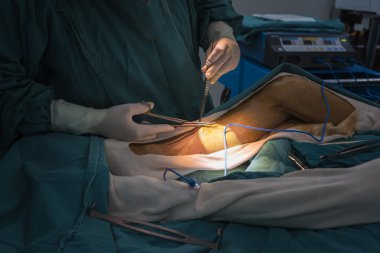 büyük Safen ven hasat için Venöz kanalı