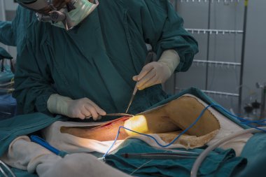 büyük Safen ven hasat için Venöz kanalı