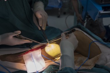 büyük Safen ven hasat için Venöz kanalı