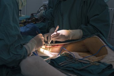 büyük Safen ven hasat için Venöz kanalı