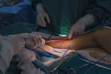 büyük Safen ven hasat için Venöz kanalı