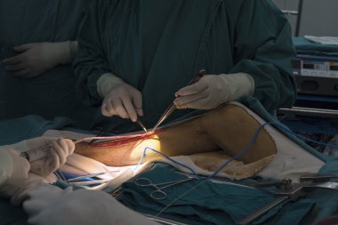 büyük Safen ven hasat için Venöz kanalı