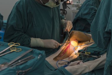 büyük Safen ven hasat için Venöz kanalı